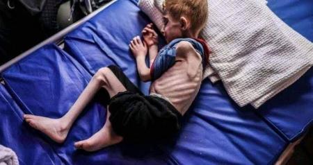  شهادت دو کودک دیگر در غزه بر اثر سوءتغذیه 